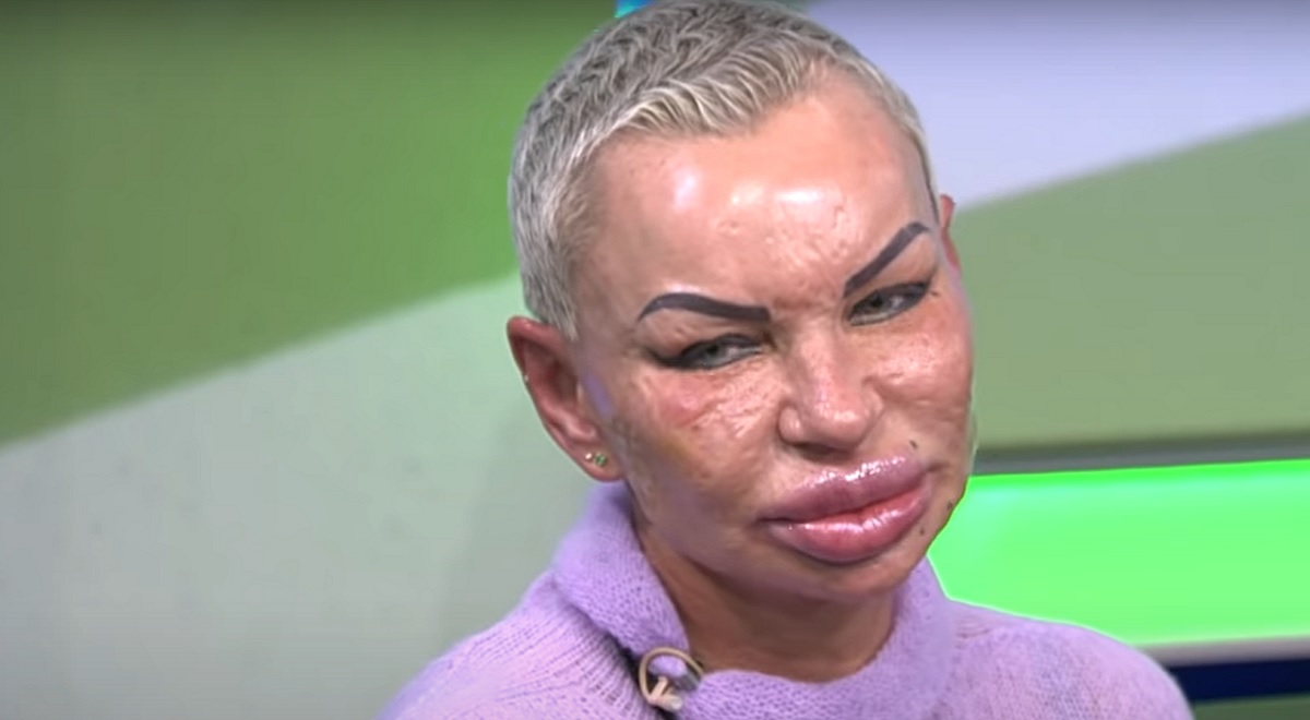 Мадам Мишель планирует скорректировать губы после травмы лица